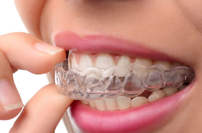 Ortodonzia Invisalign Bergamo Brescia Milano